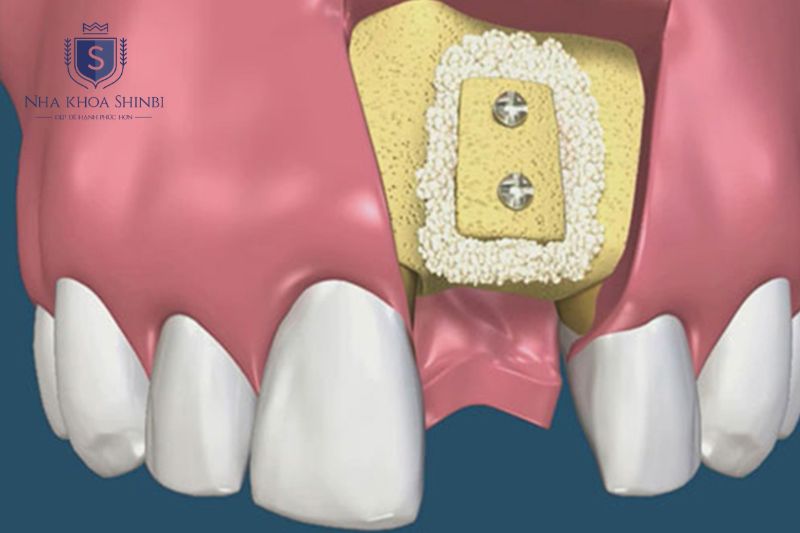 Nha Khoa Shinbi giải thích chi phí ghép xương và nâng xoang khi cấy Implant