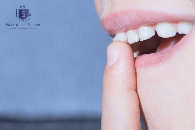 Phân loại ba tầng lung lay implant giúp xác định mức độ và hướng xử lý phù hợp