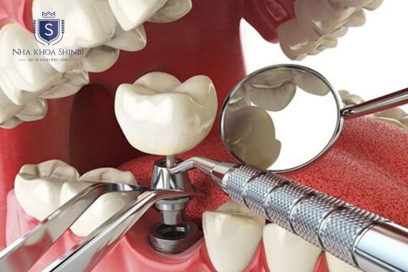 Quy trình cấy ghép Implant gồm sáu bước từ thăm khám đến hoàn tất
