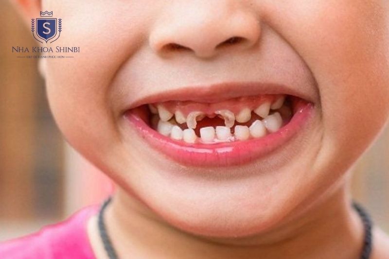 Răng cấm là răng vĩnh viễn đầu tiên và cần được bảo vệ ngay từ khi mới mọc