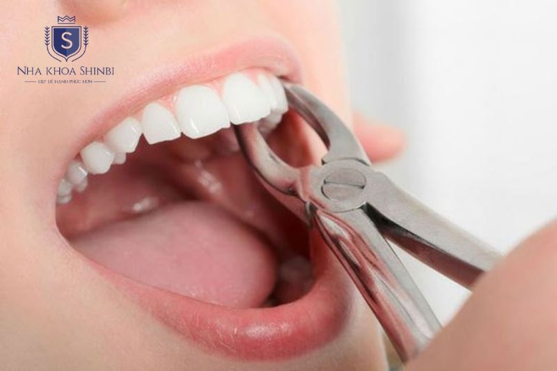 Răng sâu nặng cần nhổ và phục hình implant hoặc cầu sứ để khôi phục chức năng nhai