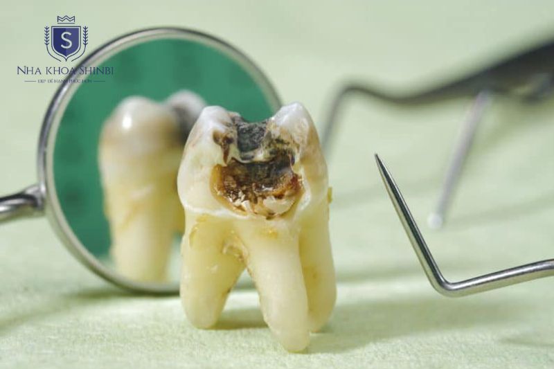 Sâu ngà gây ê buốt rõ rệt và cần trám sớm để bảo tồn răng