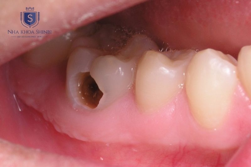 Sâu răng cấm phát hiện sớm giúp tăng khả năng bảo tồn và tránh biến chứng tủy răng
