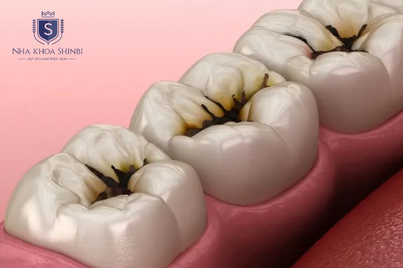 Sâu răng là quá trình axit vi khuẩn phá hủy men răng tạo lỗ trên răng