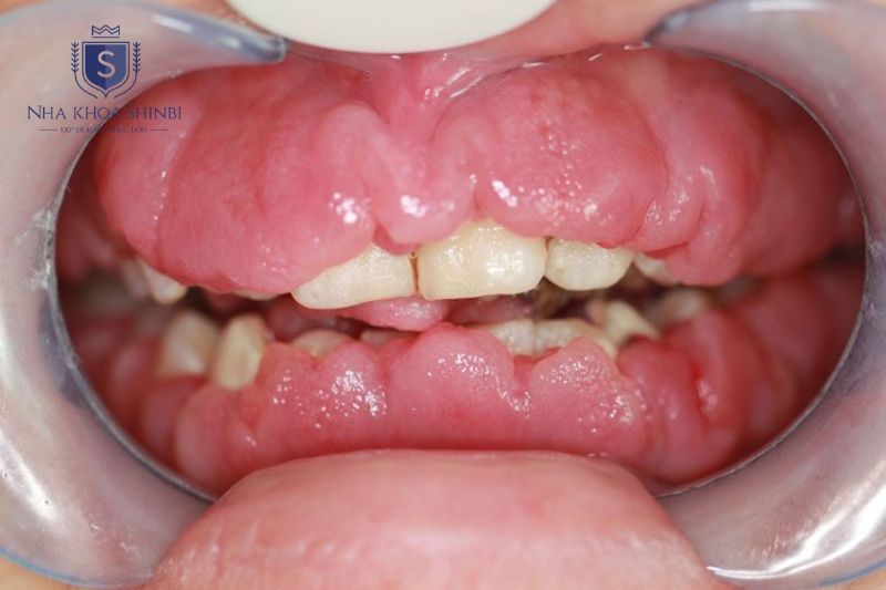 Thay đổi nội tiết và thuốc điều trị có thể làm nướu dễ viêm hơn