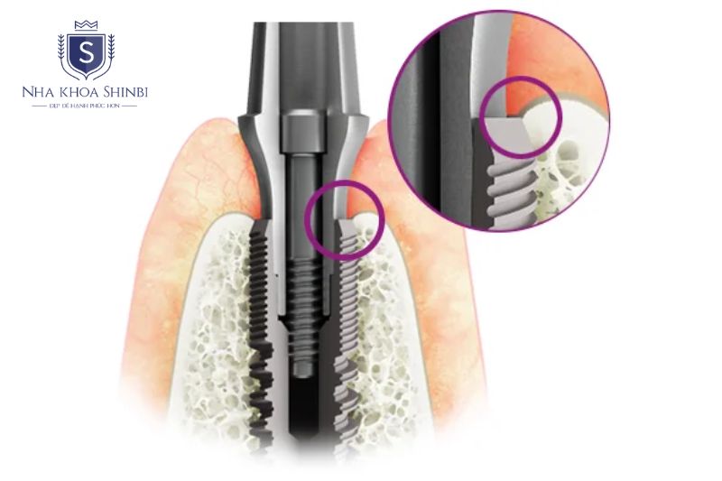 Thiết kế cổ trụ Implant như platform switching, micro-thread và Laser Lok giúp bảo tồn xương quanh nướu lâu dài