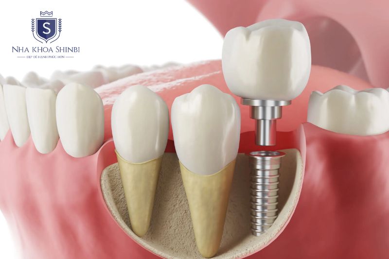 Thời gian lành thương Implant Kontact lâu hơn một số dòng Châu Âu cao cấp hơn