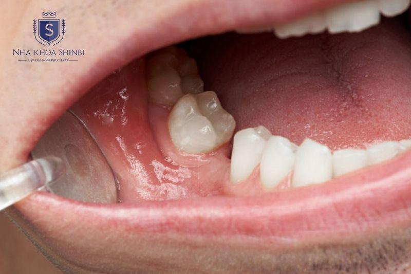 Tiêu xương hàm là tình trạng xương ổ răng suy giảm sau mất răng hoặc viêm nha chu