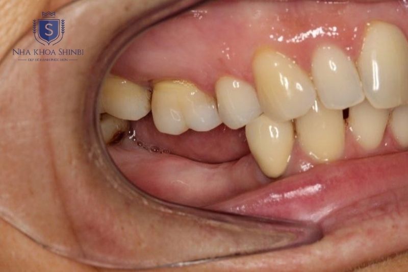 Tiêu xương hàm sau mất răng số 6 có thể cần ghép xương trước khi cấy implant
