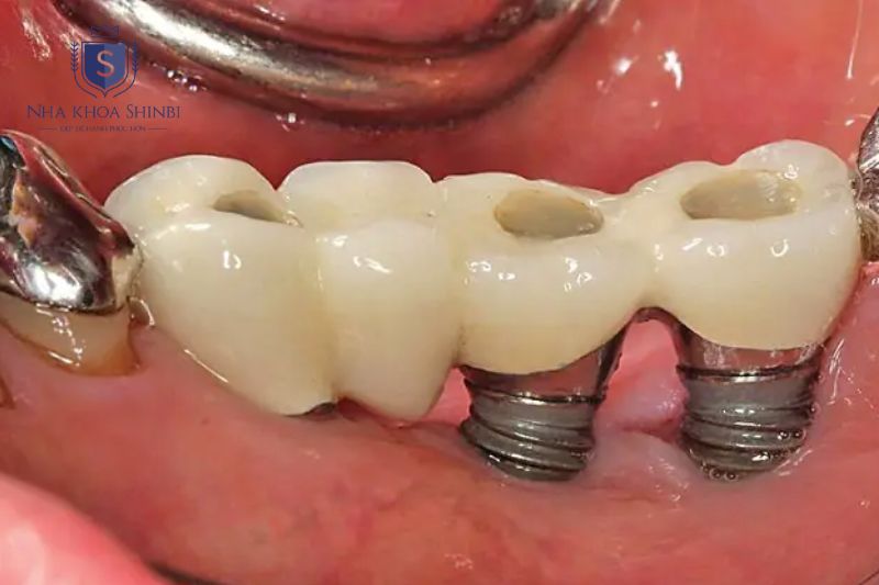Tiêu xương quanh implant làm giảm độ vững trụ do viêm hoặc yếu tố toàn thân