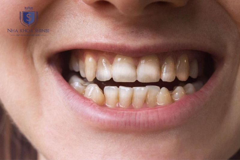 Trào ngược dạ dày gây axit mạnh phá hủy men răng dẫn đến mòn và sâu răng