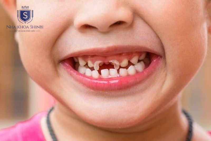 Trẻ 6 đến 8 tuổi dễ sâu răng sữa do men mỏng và vệ sinh chưa đúng cách