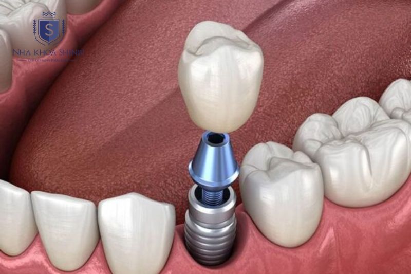 Trồng răng Implant có chi phí trọn gói từ 25 đến 70 triệu tùy loại trụ và mão sứ lựa chọn
