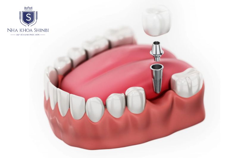 Trụ Implant Dentium phù hợp với phần lớn chỉ định cấy ghép thông thường