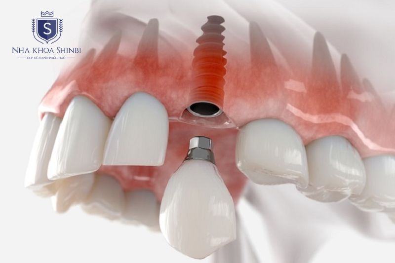Trụ Implant Dentium phù hợp với phần lớn trường hợp mất răng thông thường