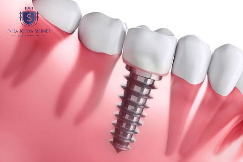 Trụ Implant Dentium tại Nha Khoa Shinbi có giá 18.000.000 VND