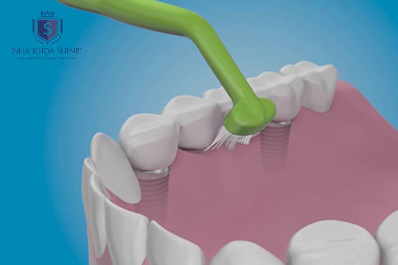 Vệ sinh implant cần chỉ nha khoa bàn chải kẽ và tăm nước để làm sạch vùng cổ trụ