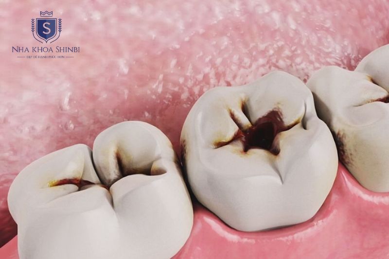 Vi khuẩn đường ăn và vệ sinh kém gây axit phá hủy men răng dẫn đến sâu răng