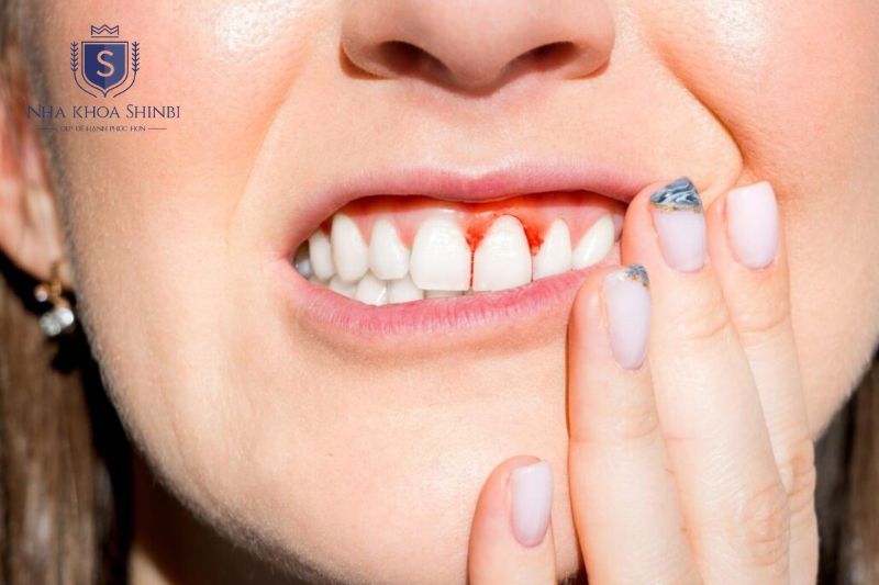 Viêm lợi cần được kiểm soát sớm để tránh biến chứng nguy hiểm