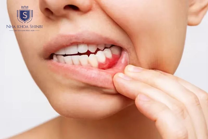 Viêm lợi kéo dài cần thăm khám nha khoa để loại bỏ cao răng hiệu quả