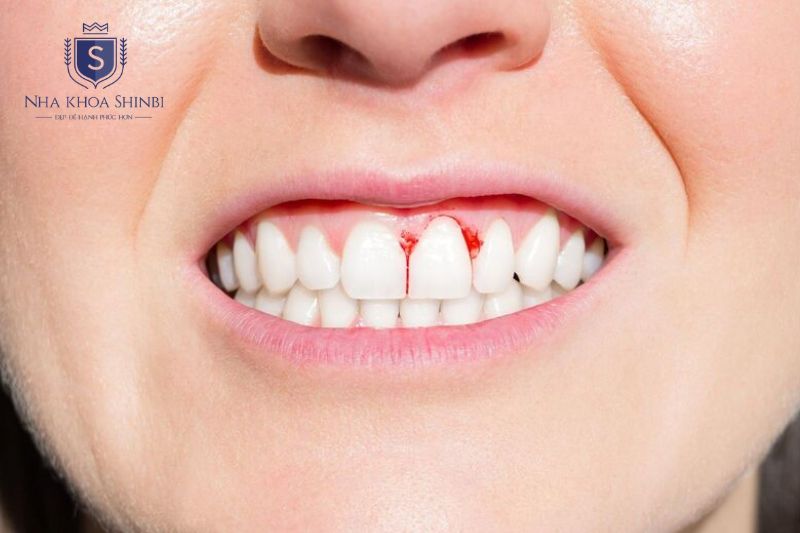 Viêm lợi là viêm giới hạn ở mô nướu bề mặt