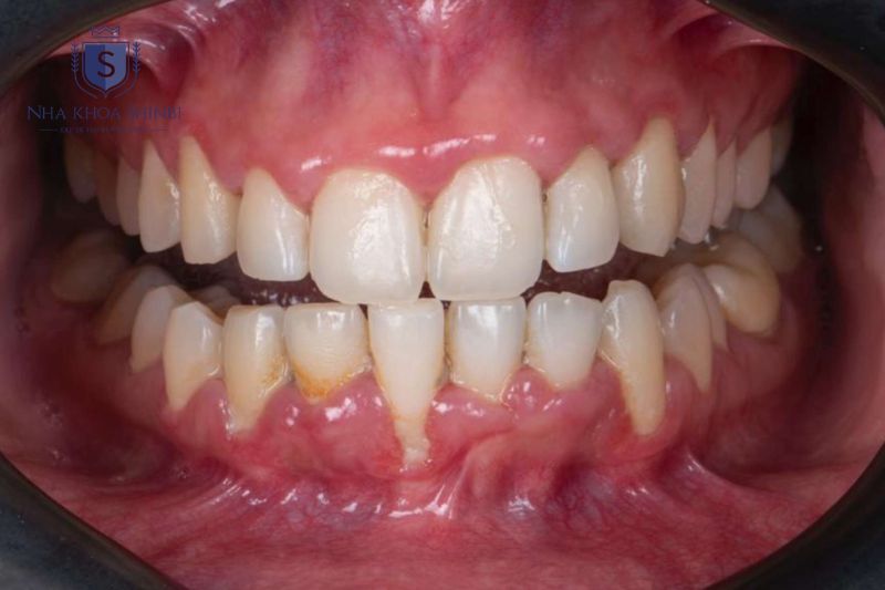 Viêm nha chu nặng gây tiêu xương và tổn thương mô nâng đỡ răng không hồi phục