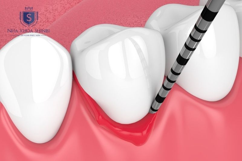 Viêm nha chu nặng và áp xe răng là nguyên nhân thường gặp gây chảy máu chân răng kéo dài
