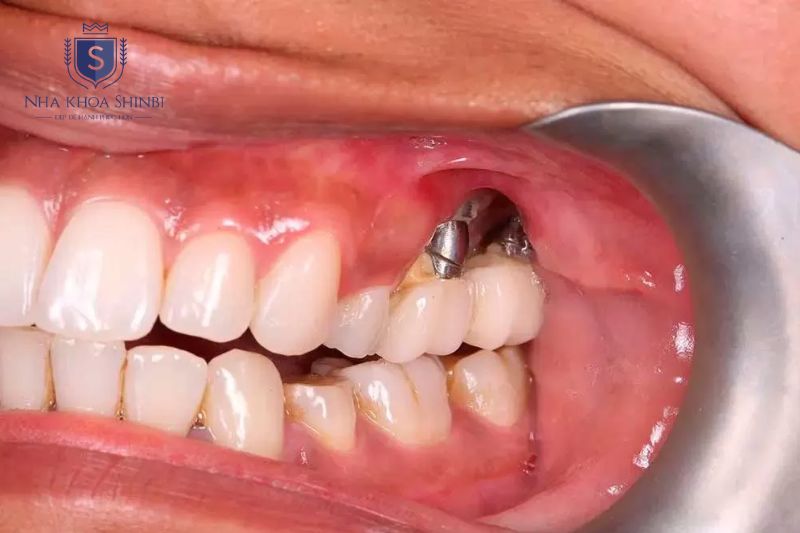 Viêm quanh trụ do vi khuẩn gây viêm nướu tiến triển đến tiêu xương nếu không điều trị