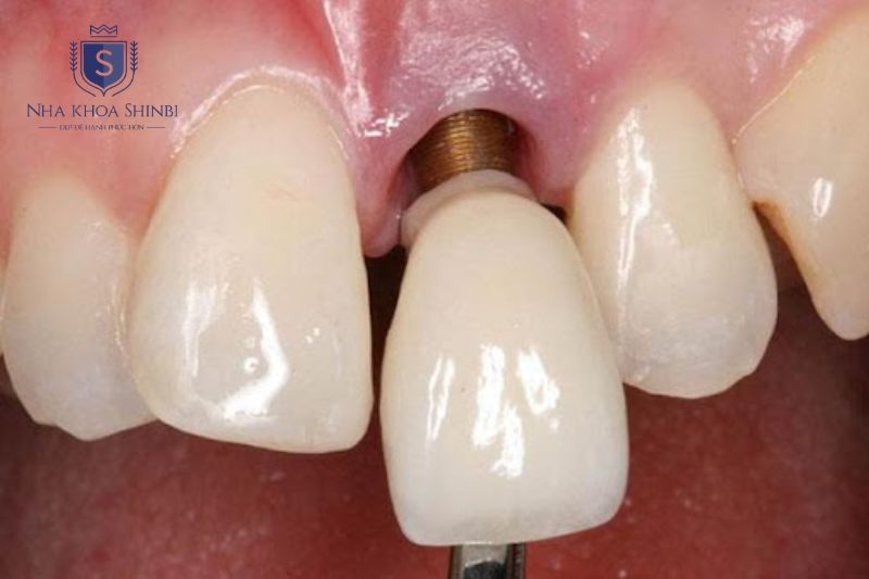Vít abutment lỏng do lực nhai lệch hoặc nghiến răng gây lung lay tầng hai