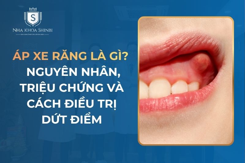 Áp Xe Răng Là Gì? Nguyên Nhân, Triệu Chứng và Cách Điều Trị Dứt Điểm