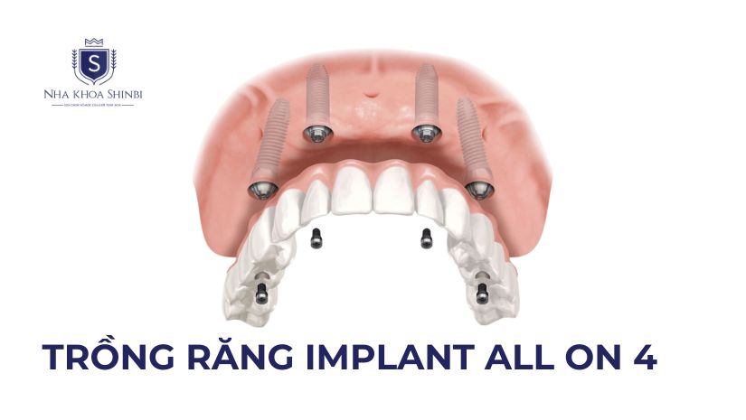 Trồng Răng Implant All on 4 Là Gì? Mức Giá Và Quy Trình Cắm Implant