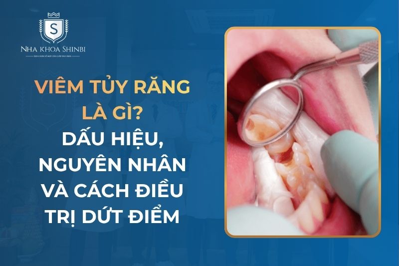 Viêm Tủy Răng Là Gì? Dấu Hiệu, Nguyên Nhân và Cách Điều Trị Dứt Điểm