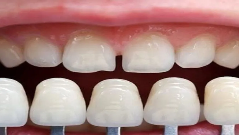 Dán sứ Veneer không mài răng: Ưu điểm, giá bao nhiêu