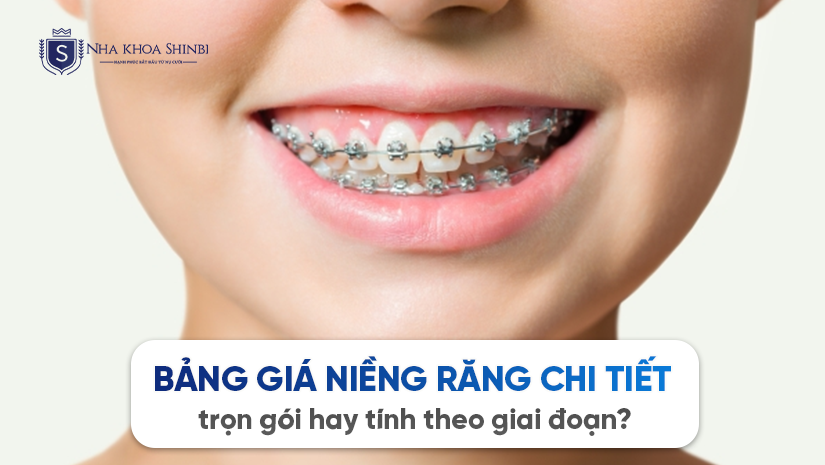 Bảng giá niềng răng chi tiết: trọn gói hay tính theo giai đoạn?