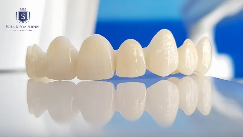 Bọc răng sứ không kim loại có nên hay không? Cần lưu ý gì?