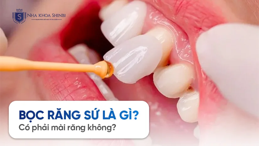 Bọc răng sứ là gì? Có phải mài răng không?