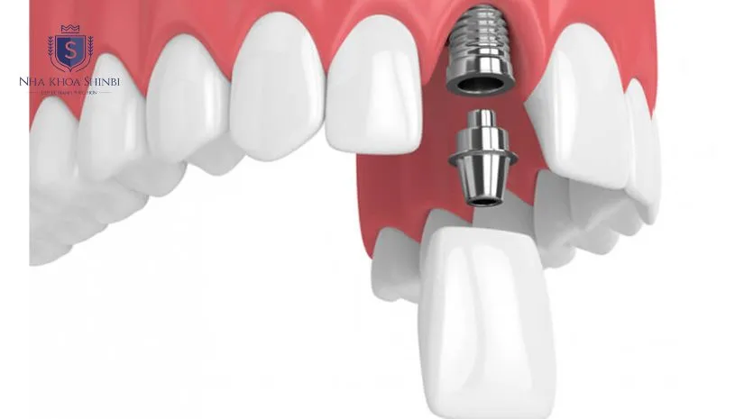 Cấy ghép Implant răng cửa: Phương pháp và chi phí