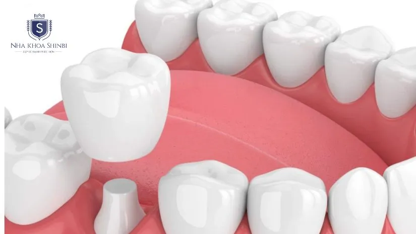 Khi nào phải bọc răng sứ? Các dấu hiệu cảnh báo sớm