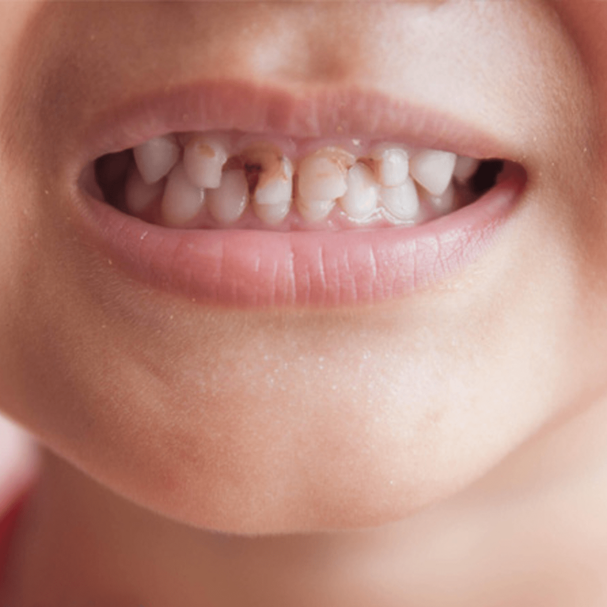 Chụp mão sứ răng sữa cá nhân hóa