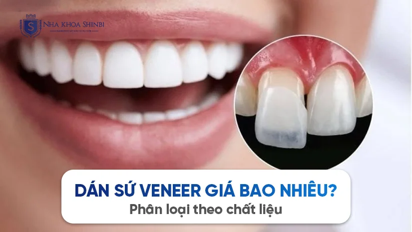 Dán sứ Veneer giá bao nhiêu? Phân loại theo chất liệu
