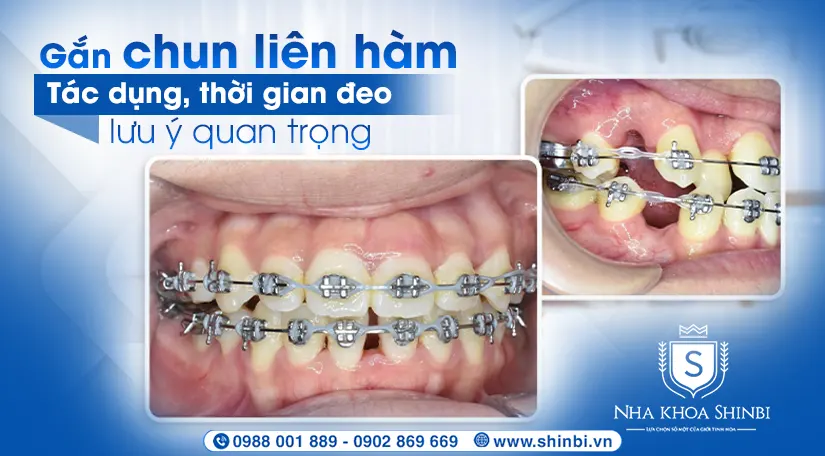 Gắn chun liên hàm: tác dụng, thời gian đeo & lưu ý quan trọng