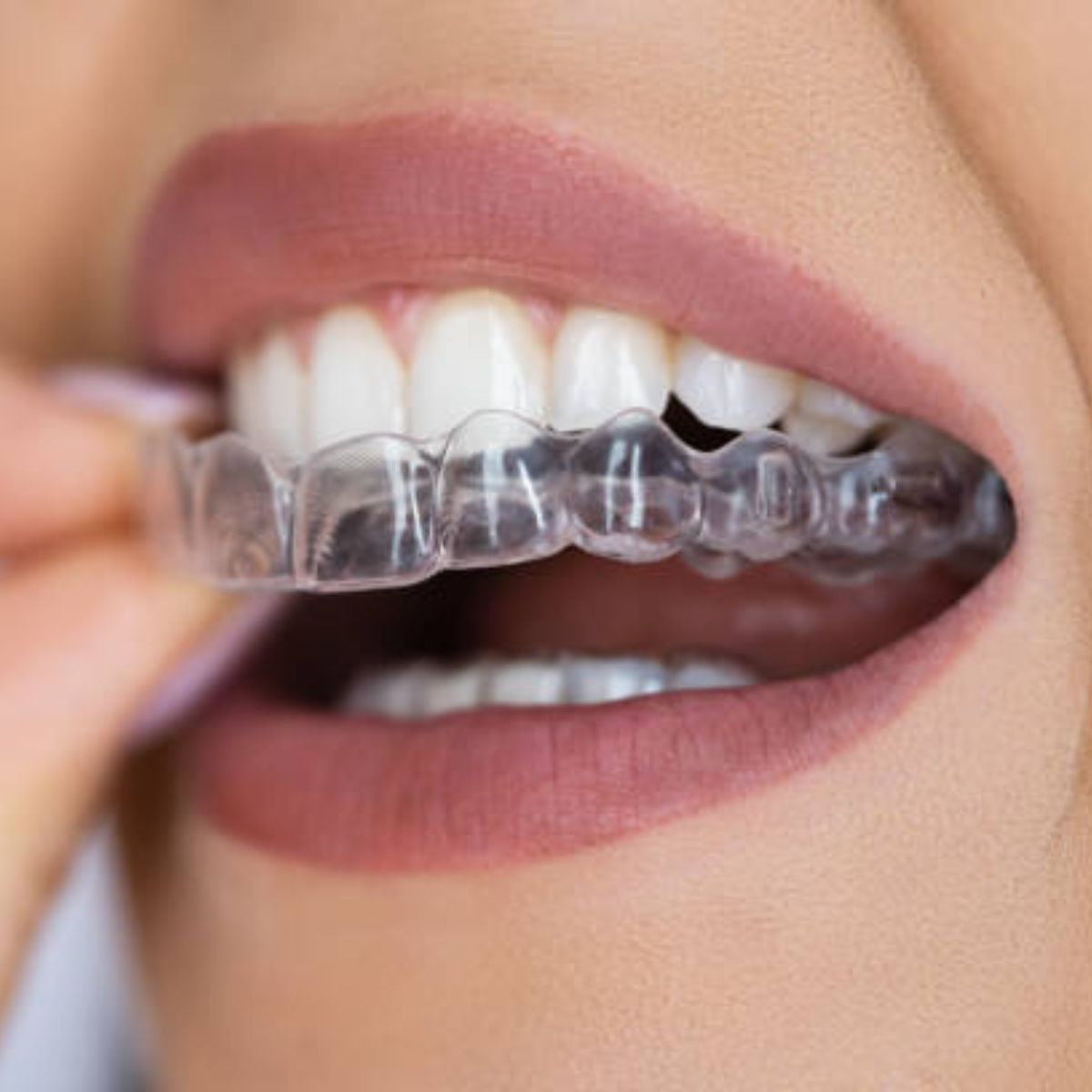 Niềng răng trong suốt Invisalign Comp 3 năm