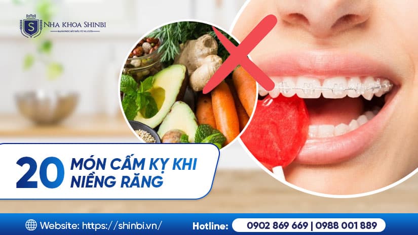 Niềng răng có phải kiêng gì? Danh sách 20 món nên tránh