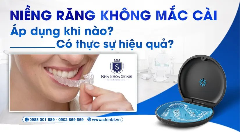 Niềng răng không mắc cài: áp dụng khi nào? Có thực sự hiệu quả?