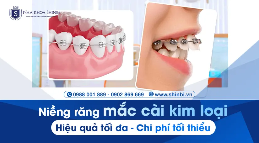 Niềng răng mắc cài kim loại: Hiệu quả tối đa, chi phí tối thiểu