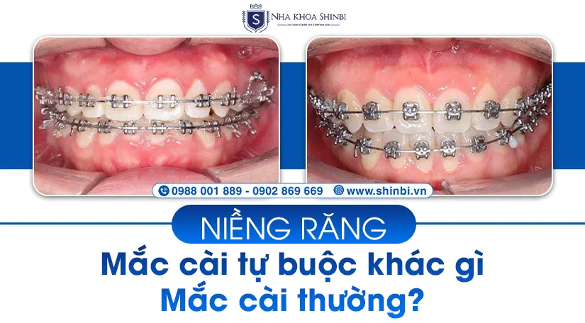 Niềng răng mắc cài tự buộc khác gì mắc cài thường?