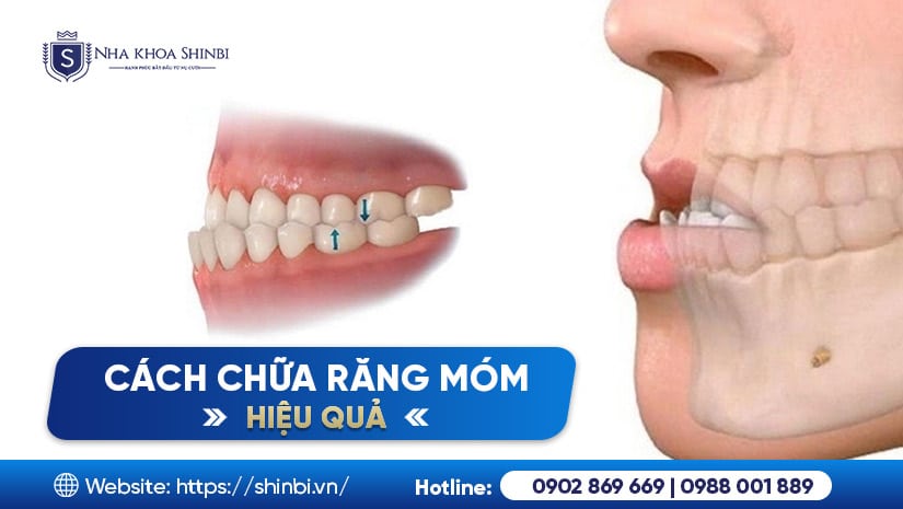 Niềng răng móm: phương pháp phù hợp cho từng mức độ