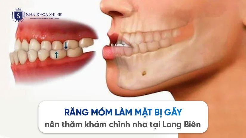 Răng móm làm mặt bị gãy nên thăm khám chỉnh nha tại đâu gần Long Biên