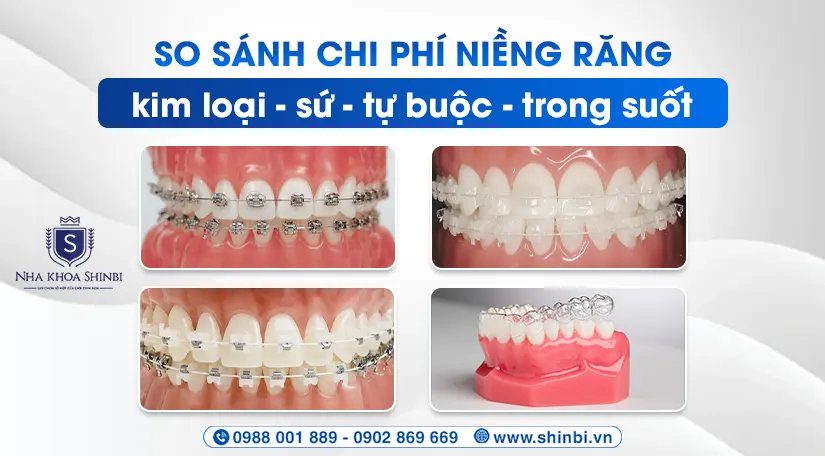 So sánh chi phí niềng răng: kim loại – sứ – tự buộc – trong suốt