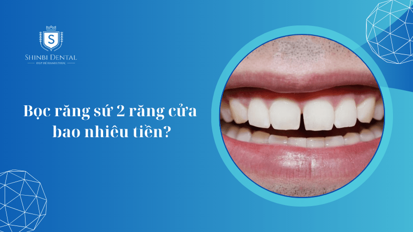 Bọc răng sứ 2 răng cửa bao nhiêu tiền? Báo giá mới nhất